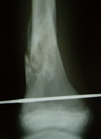 Fibrous Cortical Defect Femur Fracture